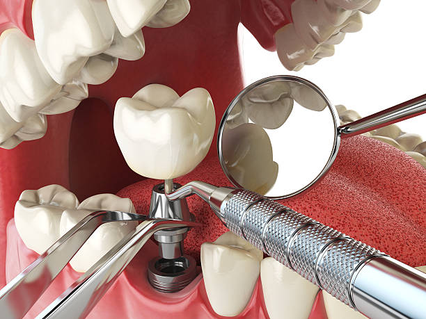 Best Emergency Tooth Extraction in Lake Of The Pines, CA